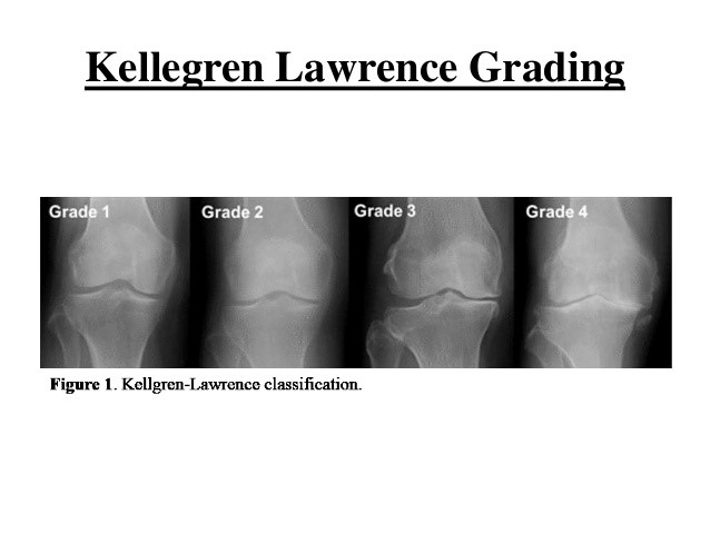 درمان آرتروز زانو